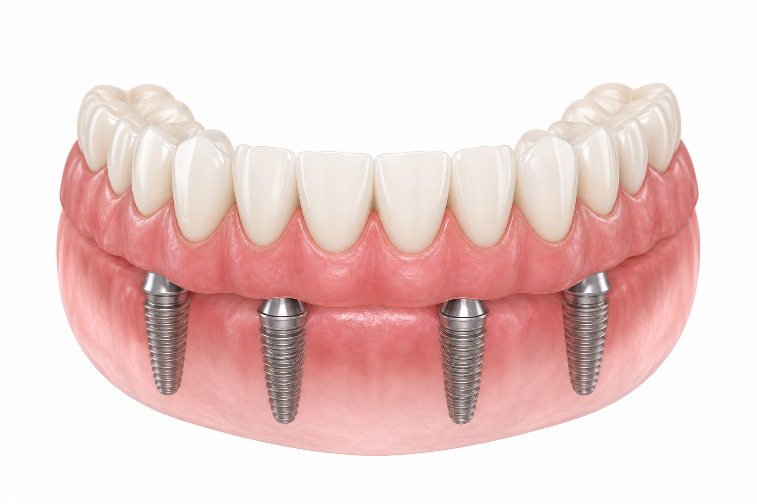 All-On-X Implants procedure illustration at Doctor Dental in Tujunga
