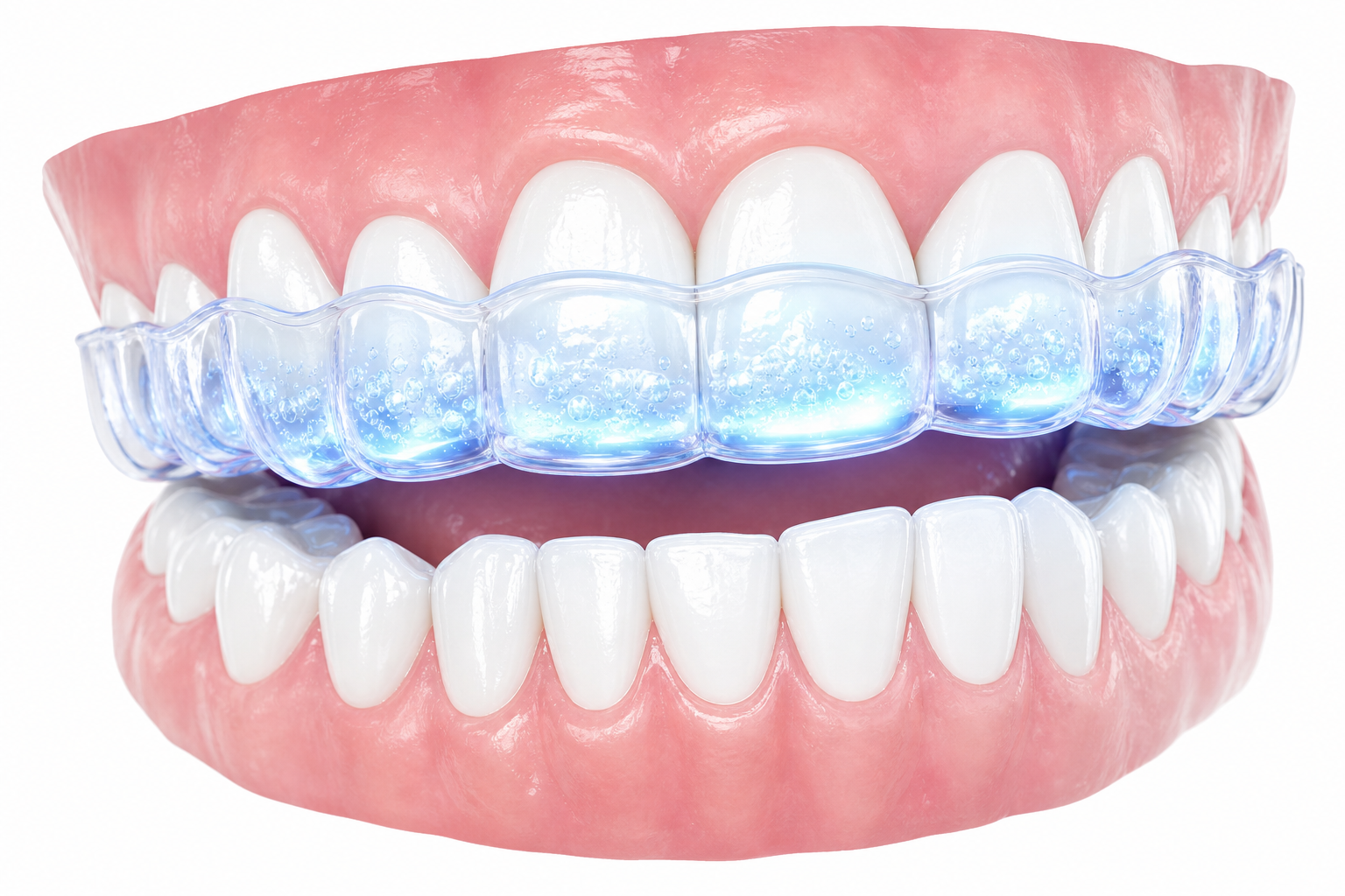 Teeth Whitening procedure illustration at Doctor Dental in Tujunga