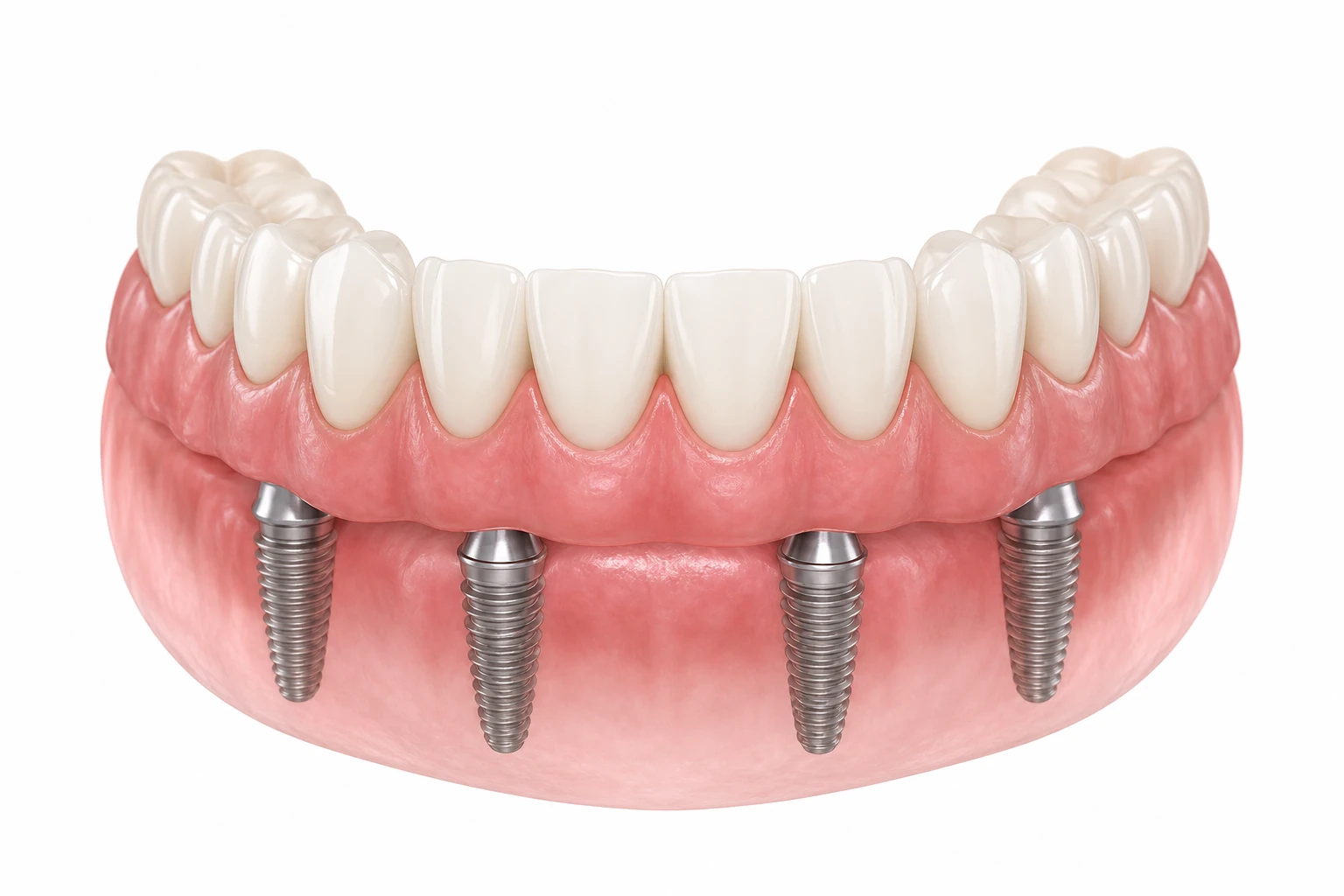 All-On-X Implants procedure illustration at Doctor Dental in Tujunga
