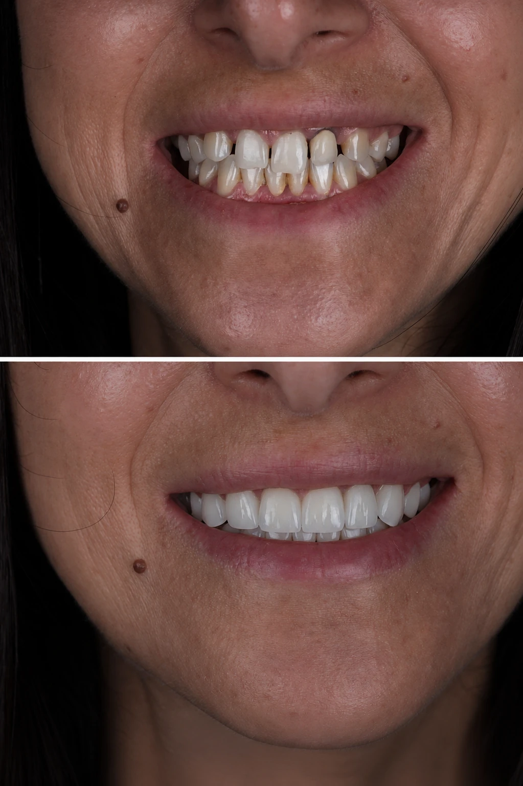 Before and after smile transformation – Doctor Dental Case 5