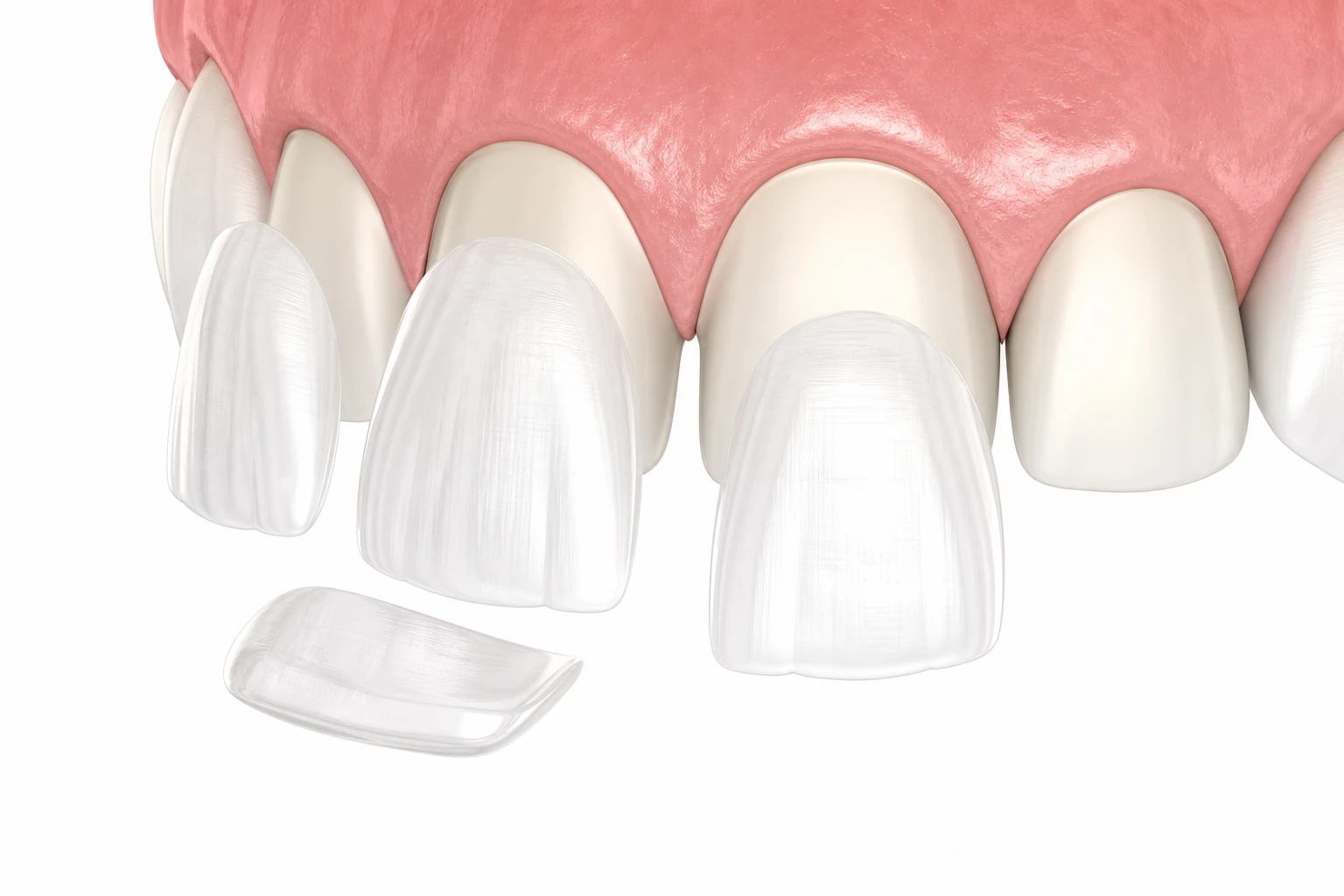Veneers procedure illustration at Doctor Dental in Tujunga